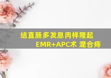 结直肠多发息肉样隆起 EMR+APC术 混合痔